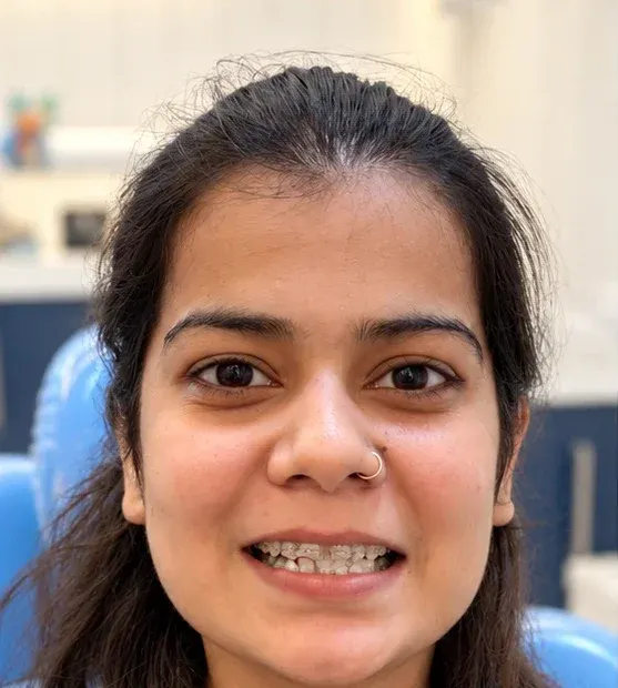 Before: the patient smiling with braces on the teeth, Roots & Pulp Dental Clinic, Aliganj, Lucknow