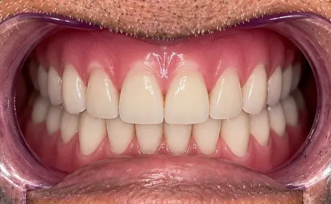 After view of the same mouth with a full set of upper and lower replacement teeth