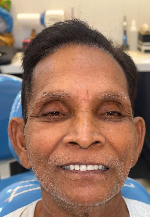 After: the same patient smiling with a full set of replacement teeth