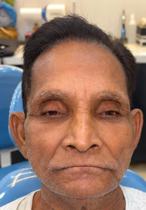 Before: the patient with lips closed over missing teeth, Roots & Pulp Dental Clinic, Aliganj, Lucknow