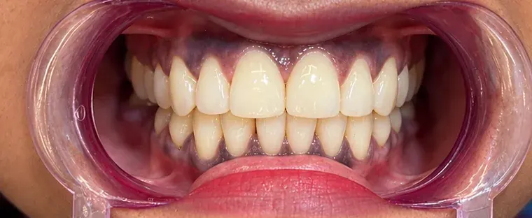 After view of the same upper front teeth with the gap closed