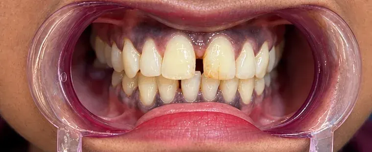 Before view of a gap between the upper front teeth, Roots & Pulp Dental Clinic, Aliganj, Lucknow