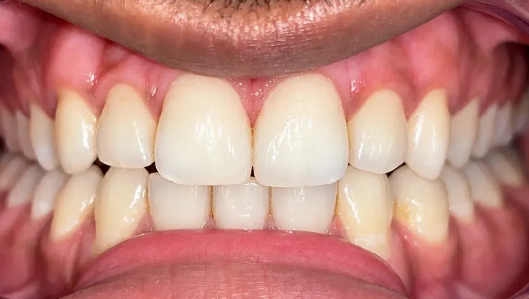 After view of the same upper front teeth with the gap closed