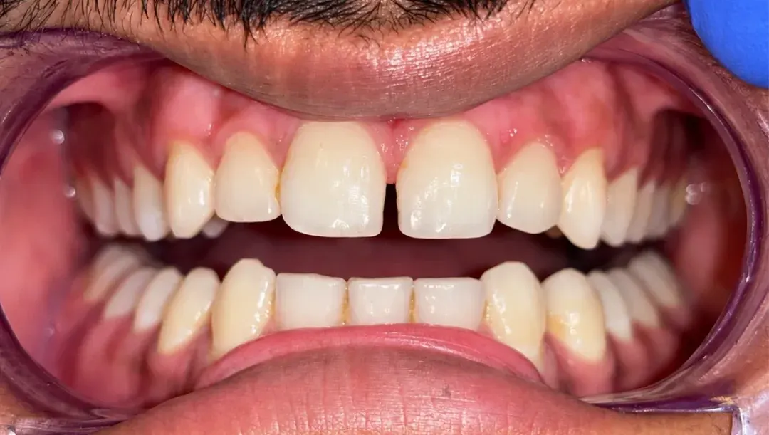 Before view of a visible gap between the upper front teeth, Roots & Pulp Dental Clinic, Aliganj, Lucknow