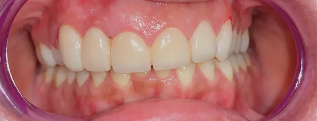 After view of a complete, even row of upper front teeth