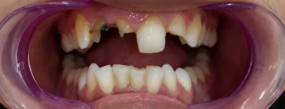 Before view of broken, decayed and missing upper front teeth, Roots & Pulp Dental Clinic, Aliganj, Lucknow