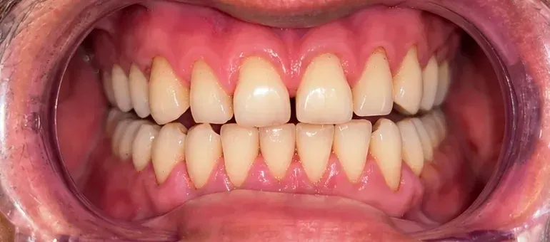 After view of the same teeth with the brown staining lightened