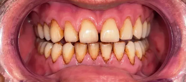 Before view of brown staining on the upper and lower teeth, Roots & Pulp Dental Clinic, Aliganj, Lucknow