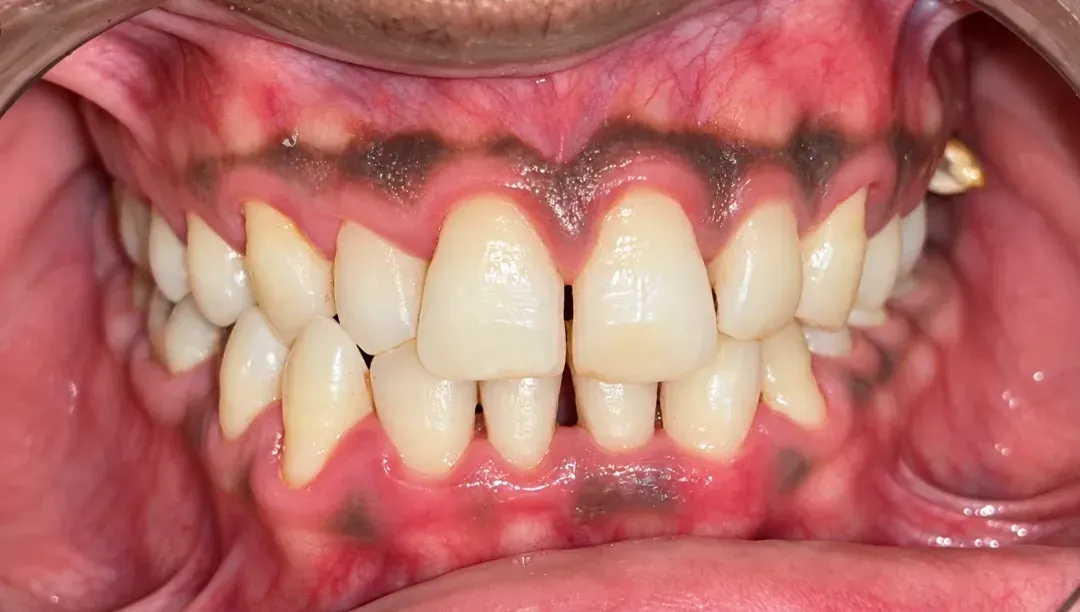 After view of the same teeth cleaned of stains and tartar