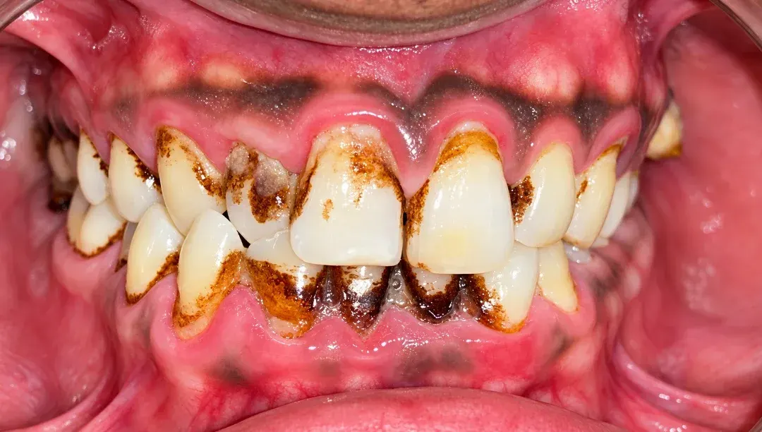 Before view of teeth with heavy brown stains and tartar along the gum line, Roots & Pulp Dental Clinic, Aliganj, Lucknow