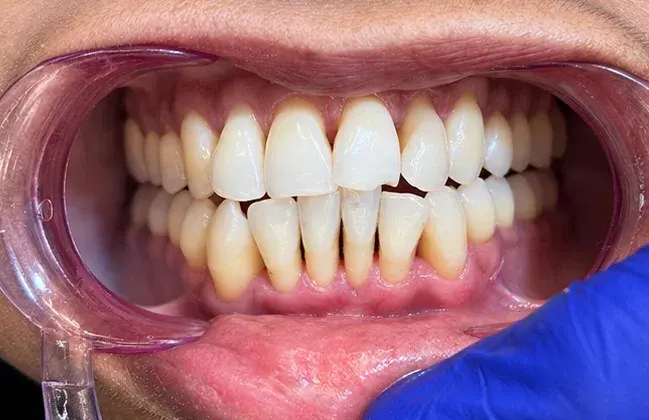 After view of the same lower front teeth cleaned of tartar