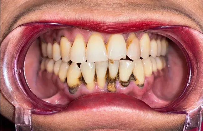 Before view of dark tartar deposits on the lower front teeth, Roots & Pulp Dental Clinic, Aliganj, Lucknow