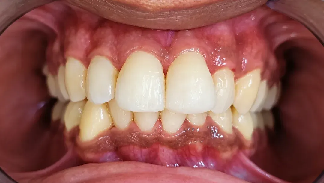 After view of the same front tooth restored to its full shape
