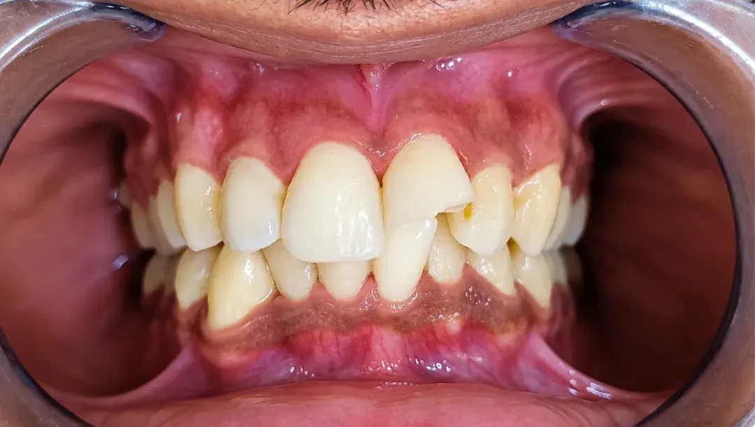 Before view of a chipped upper front tooth with a broken edge, Roots & Pulp Dental Clinic, Aliganj, Lucknow