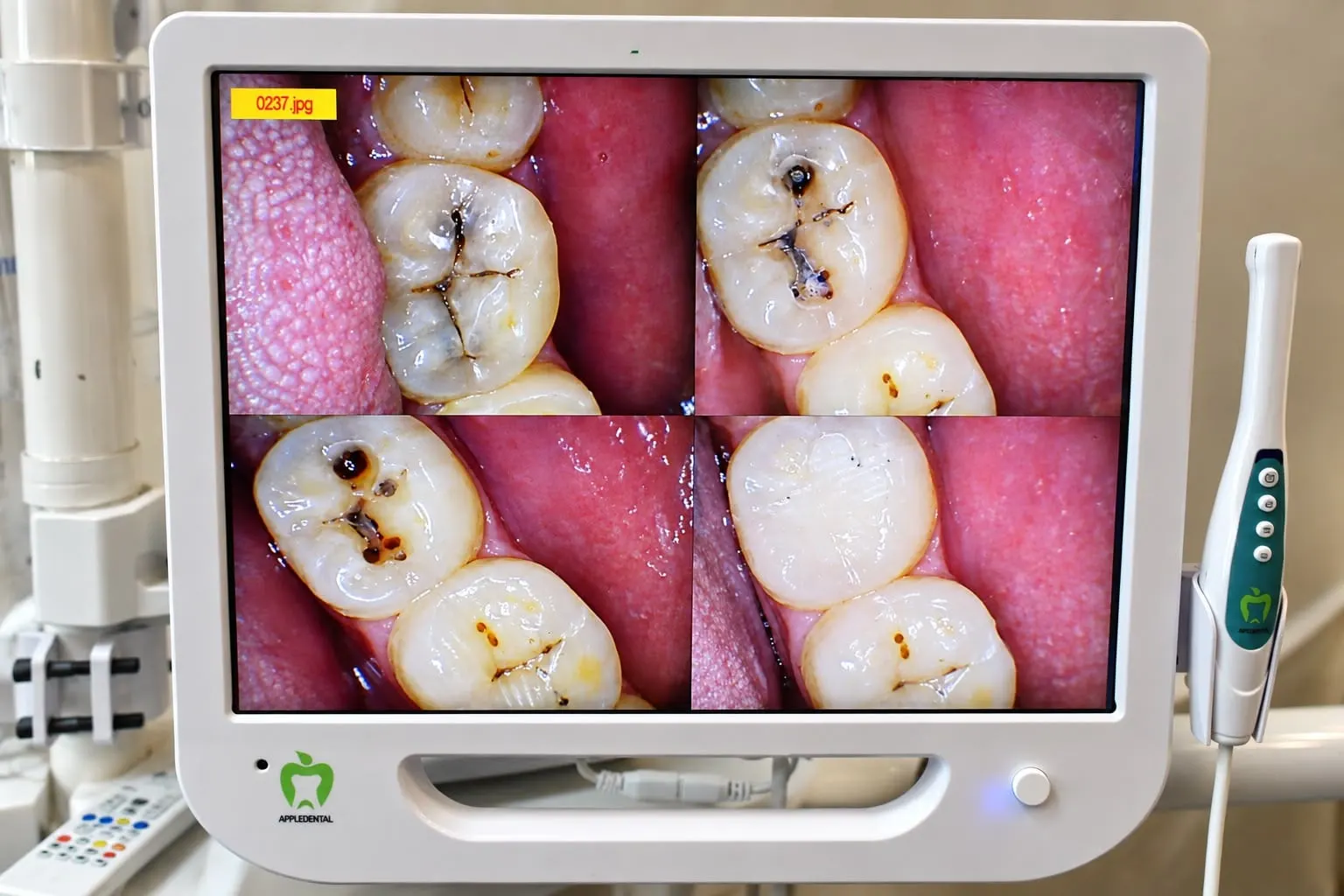 Intraoral camera screen showing cavities in the grooves of back teeth
