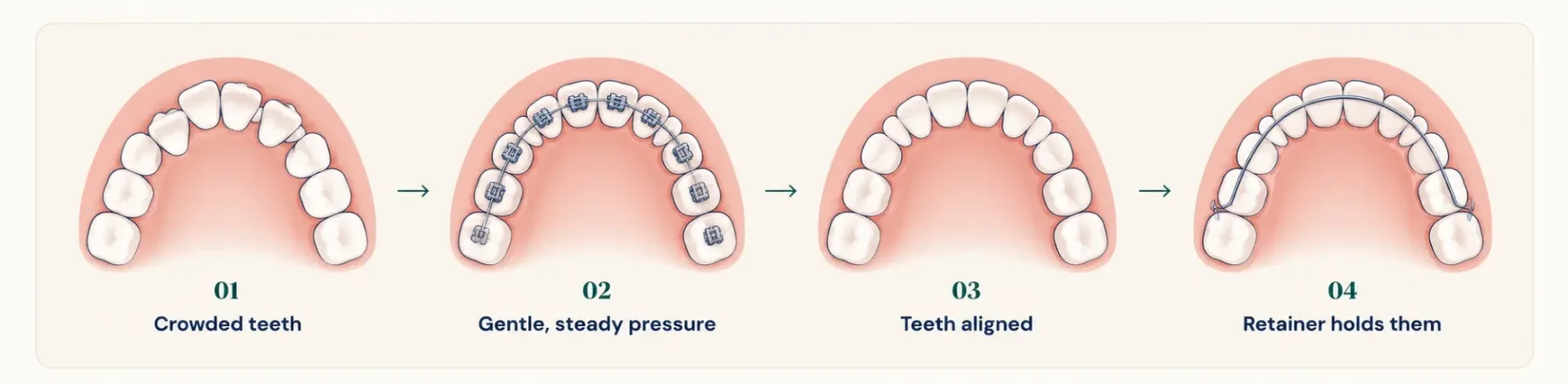 Four illustrated stages: crowded teeth, braces applying gentle steady pressure, aligned teeth, and a retainer holding them in place