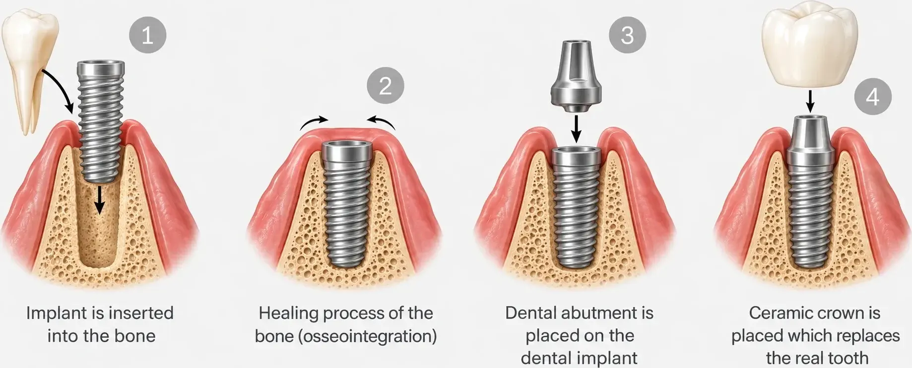 Four-stage illustration of a dental implant: the implant is placed in the bone, the bone heals around it, the connector is attached, and a crown is fitted.