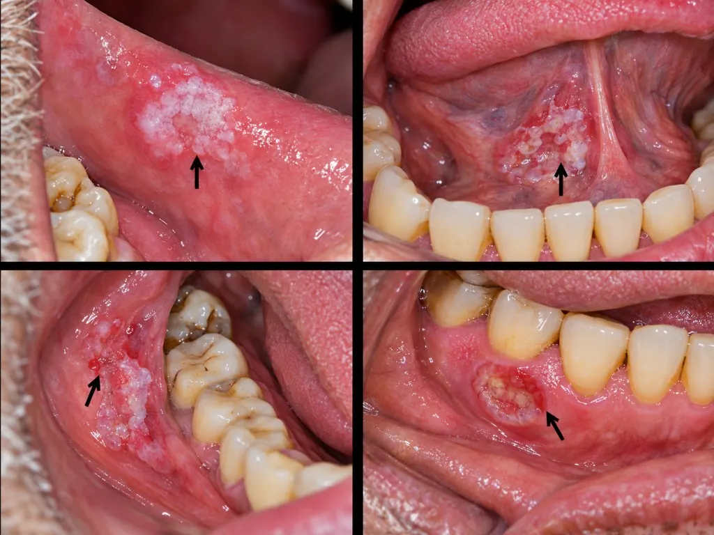 Examples of white or red patches in the mouth that a dentist would check