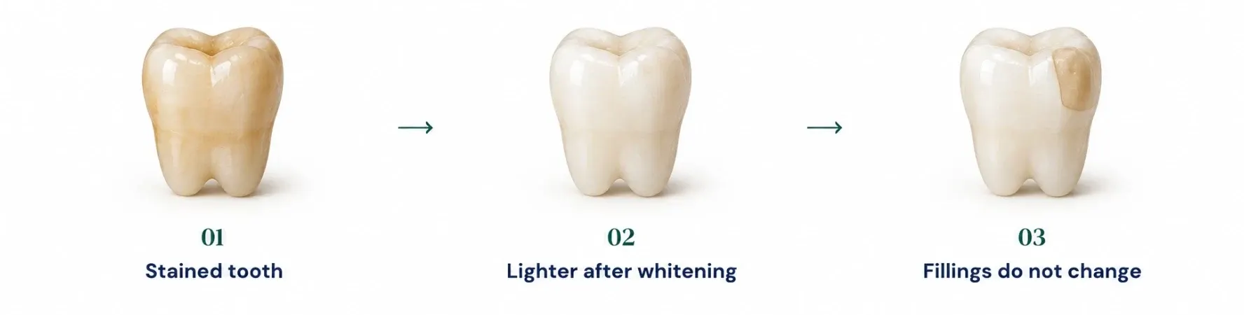 Three teeth: a stained tooth, the same tooth lighter after whitening, and a tooth whose filling keeps its original shade